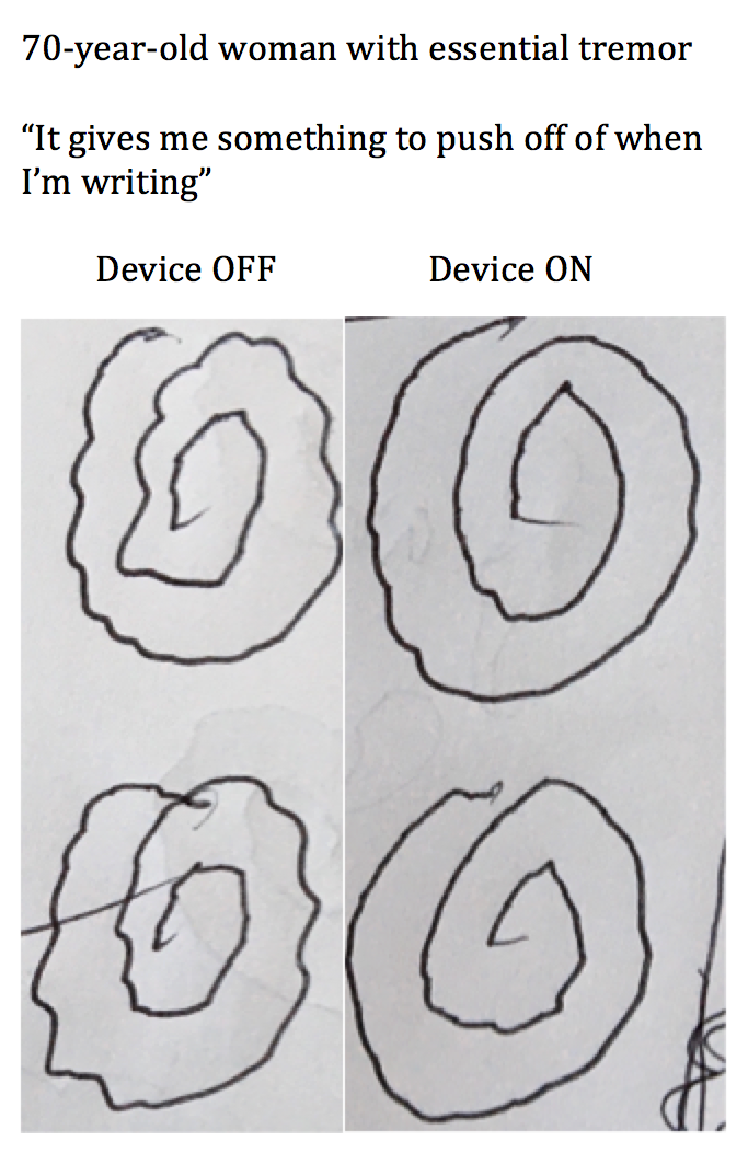 Tremor Device - Baldoni Neuromodulation